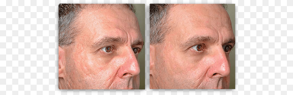 Results May Vary Profractional Laser Before And After, Adult, Person, Man, Male Png Image