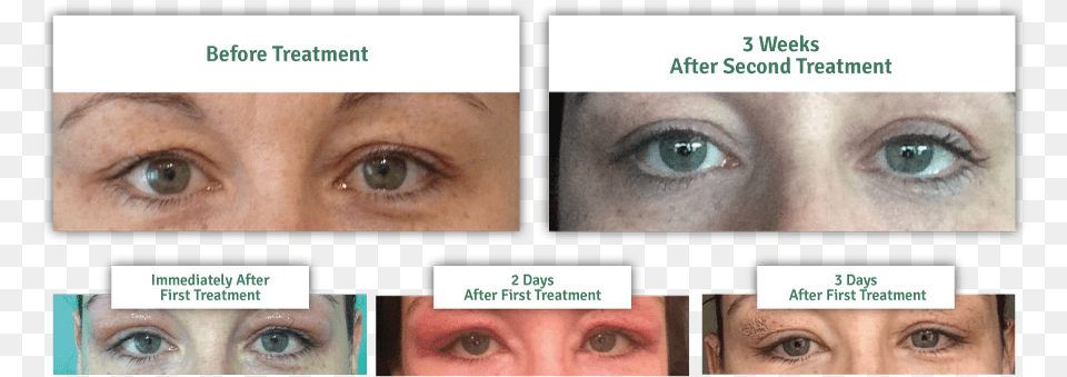 Results Of A Non Surgical Eye Lift Plasma Iq Eye Lift, Art, Collage, Face, Head Free Png