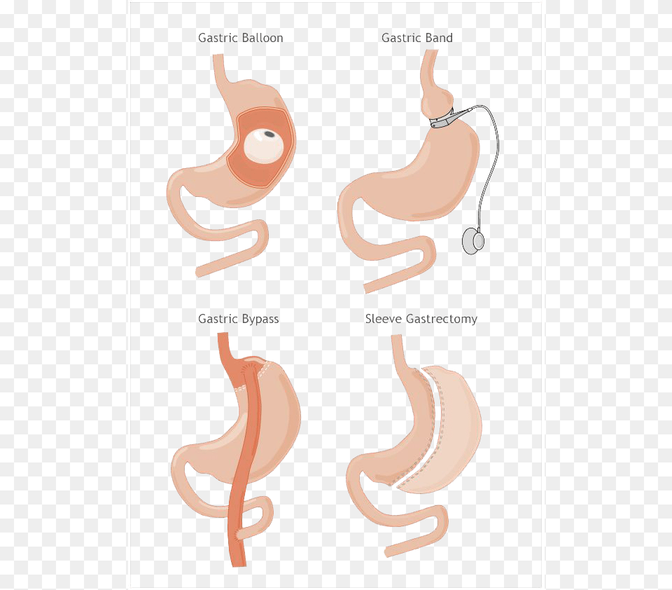 Revision Bariatric Weight Loss Surgery Octopus, Body Part, Stomach, Animal, Reptile Free Png Download