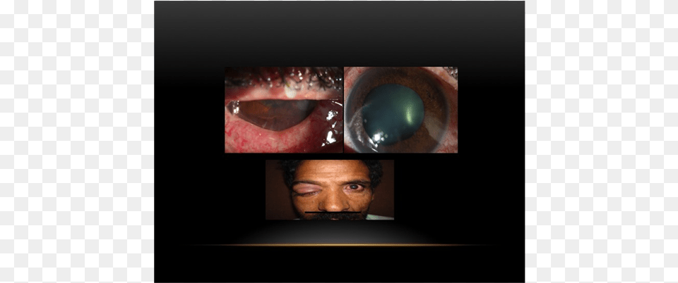 Right Eye Slit Photograph Shows Multiple Injection Cornea, Adult, Male, Man, Person Png