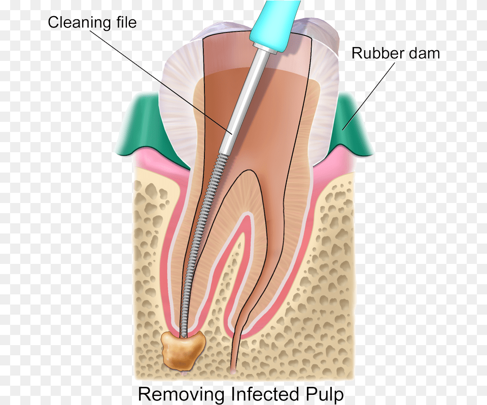 Root Canal Artificial Nerves Root Canal, Bow, Weapon, Body Part, Face Free Png Download