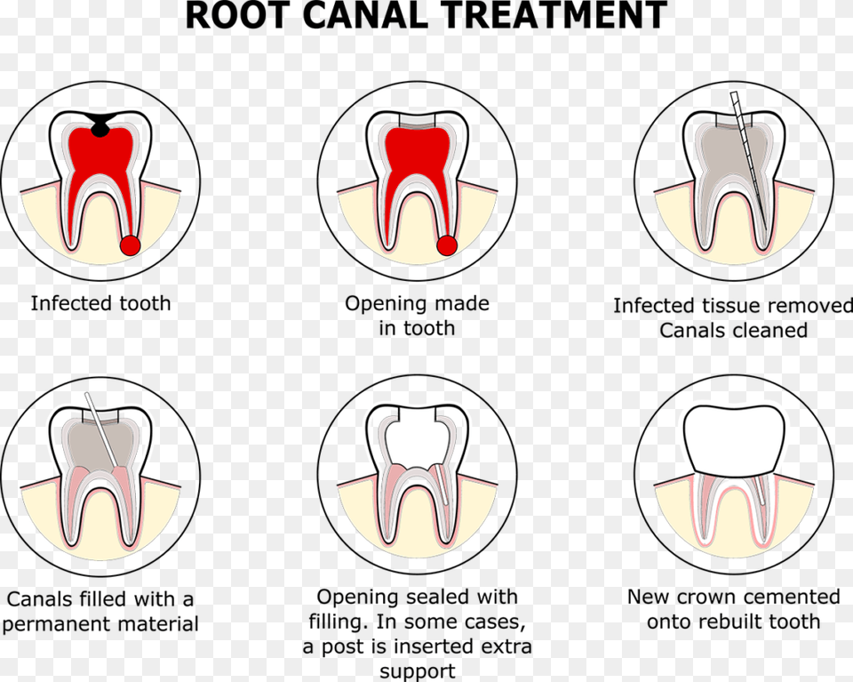 Root Canal Filling Replacement, Clothing, Footwear, Sandal Png