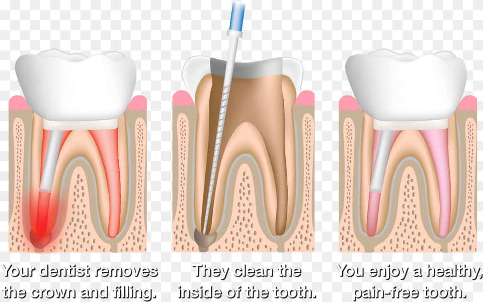Root Canal Therapy, Body Part, Mouth, Person, Teeth Png
