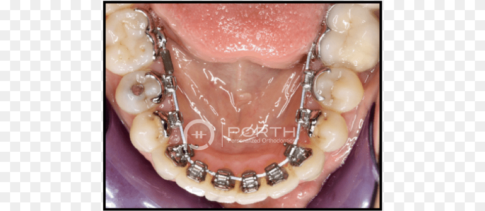 Sammamish Lingual Braces Lingual Braces, Face, Head, Person, Body Part Png