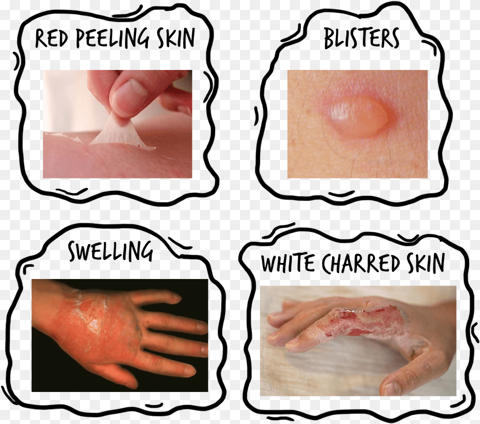 Scald Burn, Finger, Body Part, Person, Hand Free Png