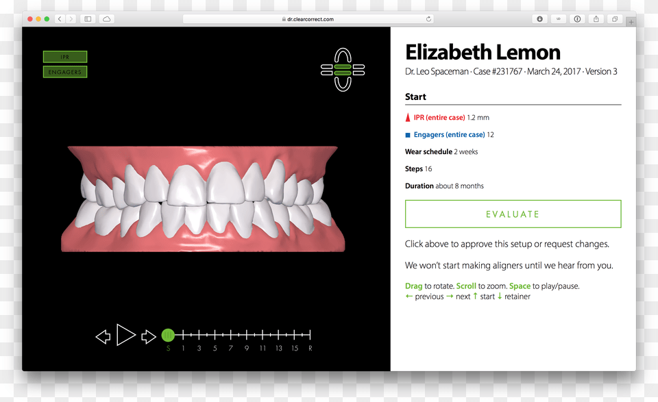 Screen Shot 2017 06 14 At Clear Correct Treatment Set Up, Body Part, Mouth, Person, Teeth Png