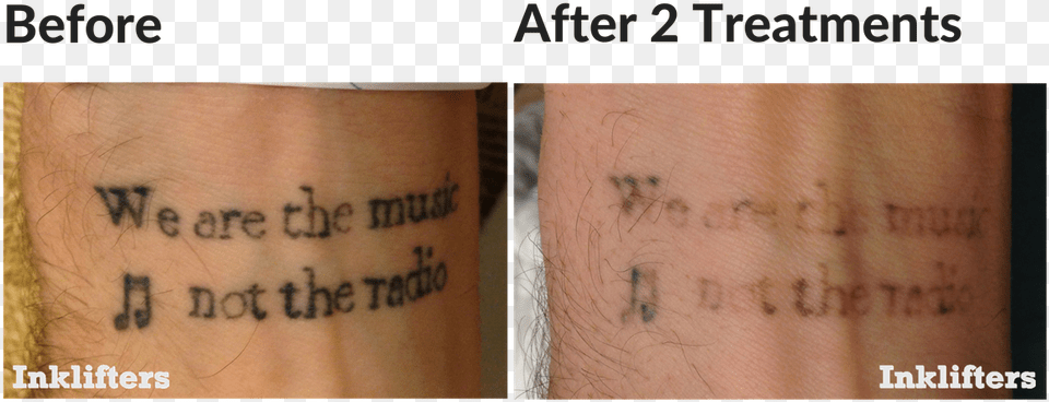 Second Treatment Laser Tattoo Removal, Body Part, Hand, Person, Skin Free Png Download