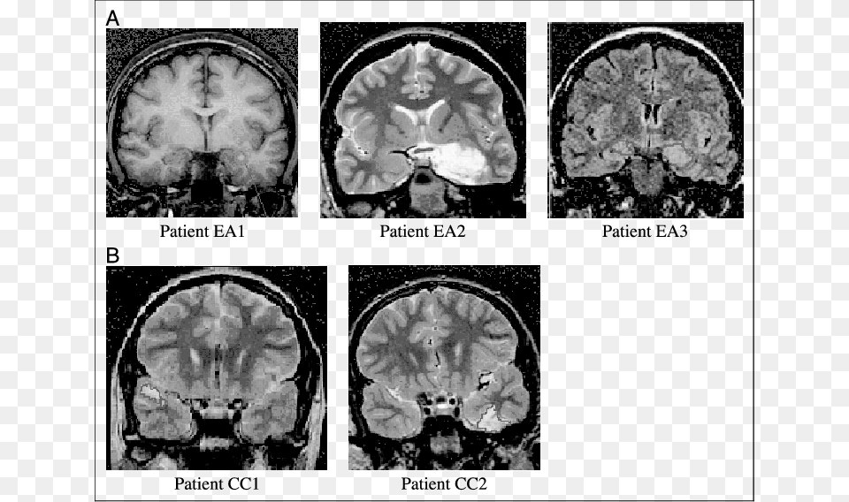Selected Mr Images Of Patients In The Early Amygdala, Ct Scan, Machine, Person, Wheel Free Transparent Png