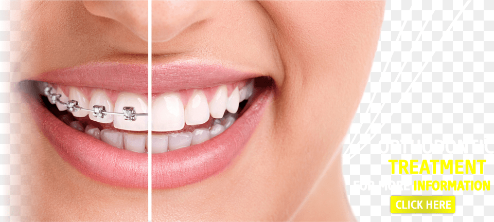 Sevgi Dental Clinic Dental Dental Clinic Dentist Braces On Vs Off Free Png