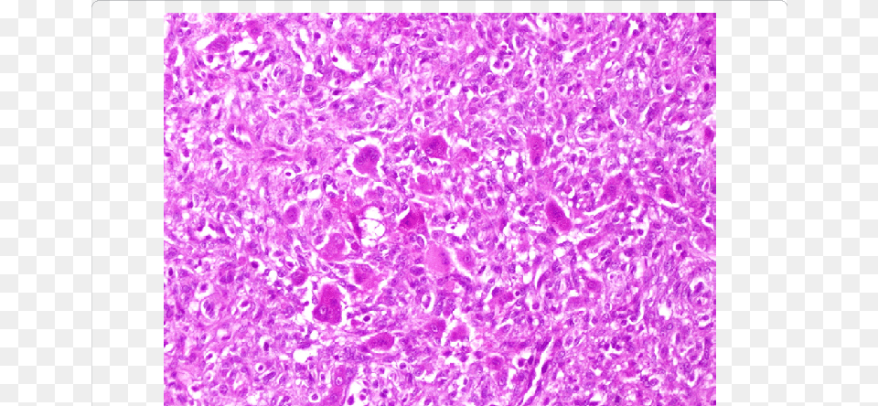 Sheets Of Mononucleated Histiocytic Cells Admixed With, Purple, Glitter Png Image