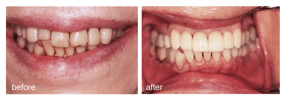Shot Of Before And After Visiting Abington Smile Gallery Aggression, Body Part, Mouth, Person, Teeth Png