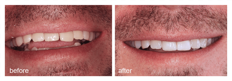 Shot Of Before And After Visiting Abington Smile Gallery Dentist, Body Part, Mouth, Person, Teeth Png Image