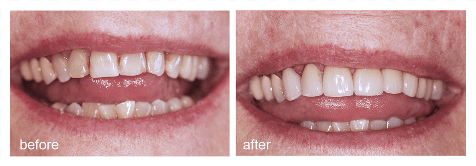 Shot Of Before And After Visiting Abington Smile Gallery Lip, Body Part, Mouth, Person, Teeth Free Png