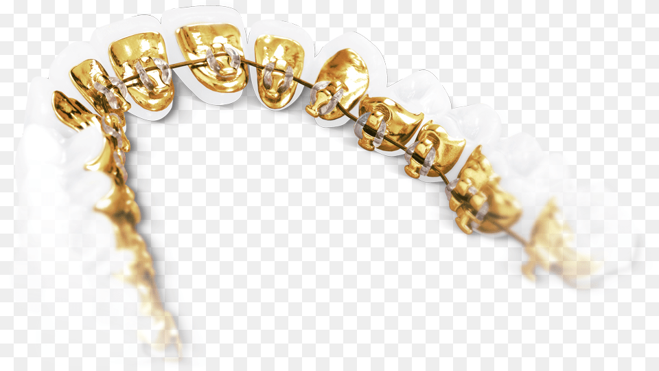 Show Your Teeth But Not Your Braces The Lingual Technique Incognito Bracket, Body Part, Mouth, Person, Accessories Free Png