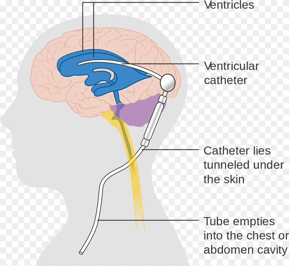 Shunt In Spine Cervical, Body Part, Face, Head, Neck Free Png Download