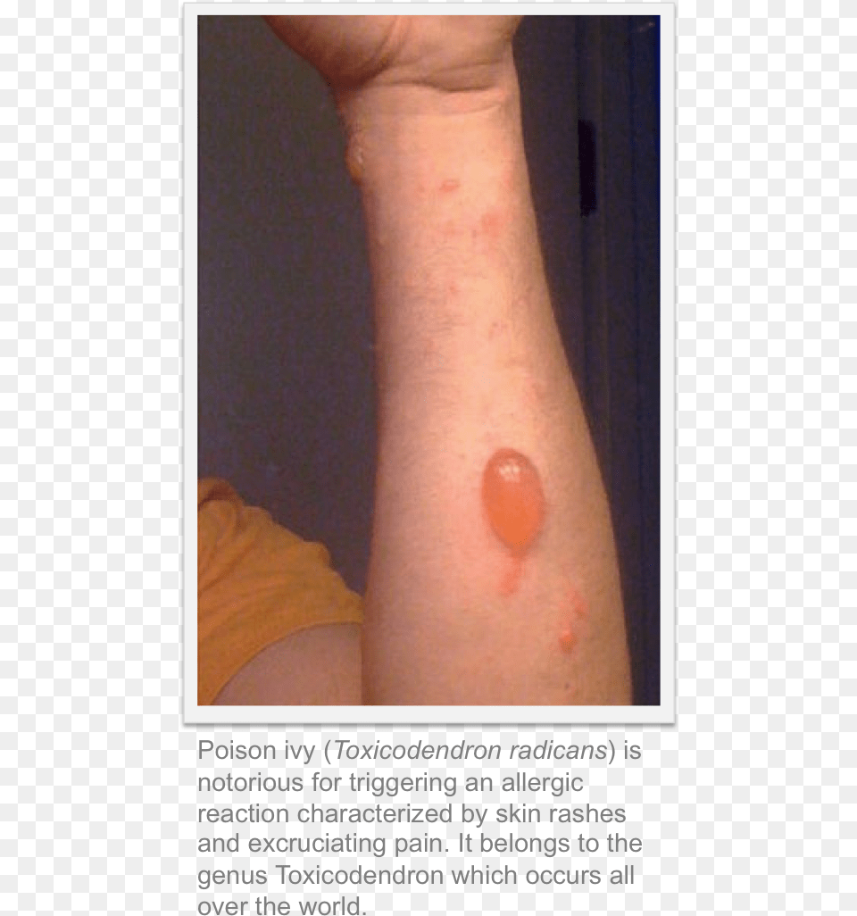 Skin Diseases Caused By Green House Gases, Arm, Body Part, Hand, Person Png