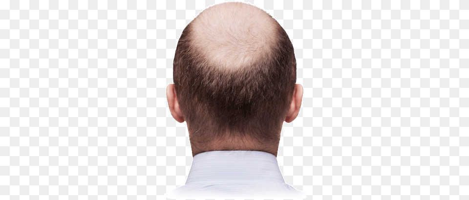 Slow Stop And Reverse Your Hair Loss Bald Man Back Of Head, Adult, Male, Person, Face Png Image