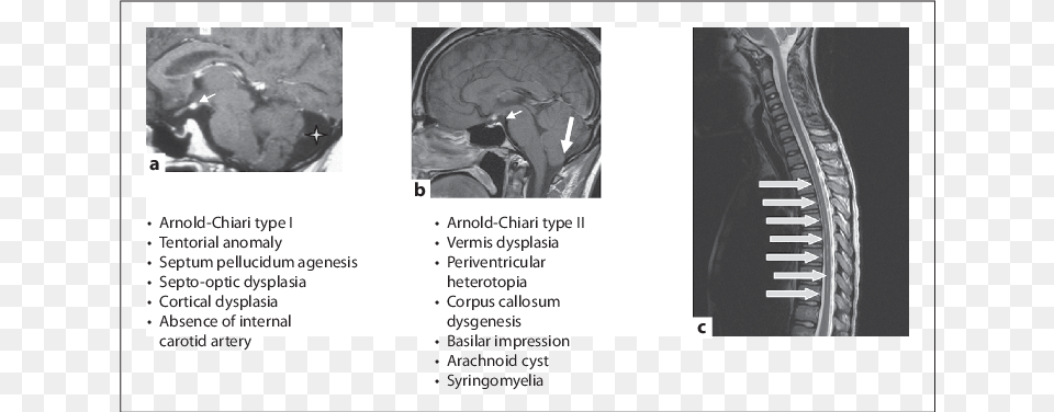 Small Arrows Showing Ectopic Posterior Pituitary In Computed Tomography, Ct Scan Png Image