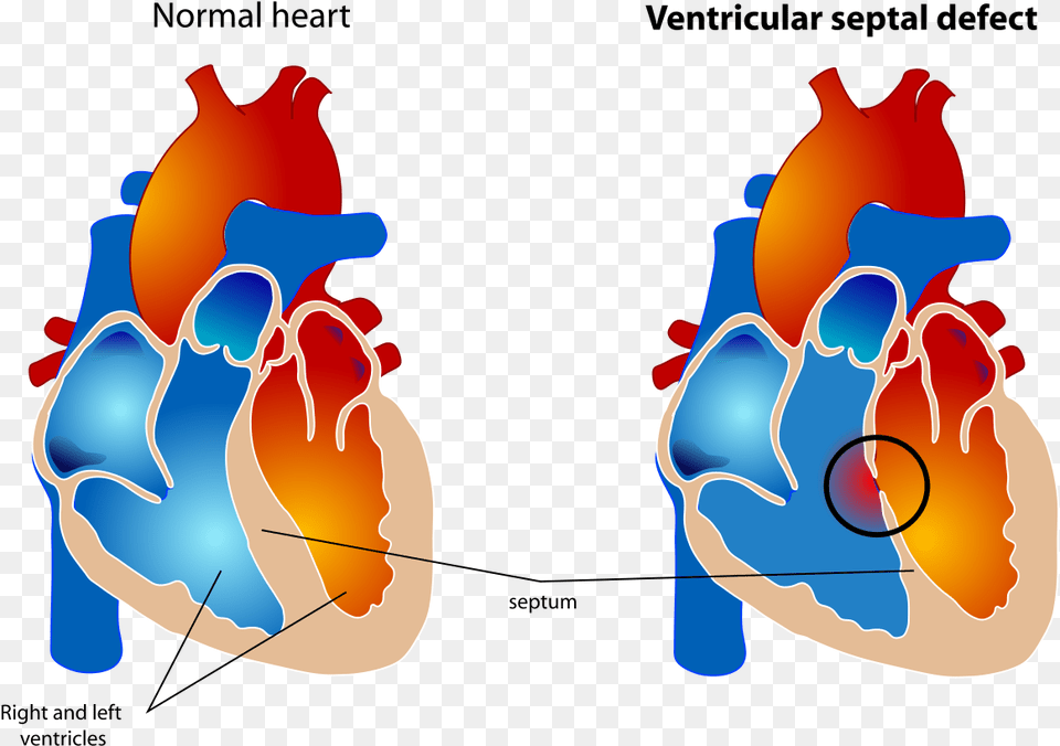 Small Ventricular Septal Defect, Ct Scan Free Transparent Png