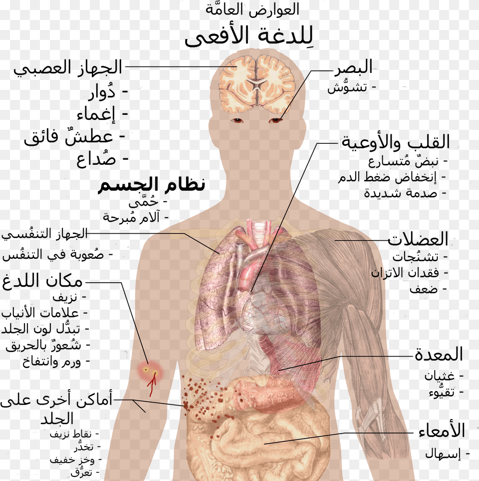 Snake Bite Symptoms Ar King Cobra Bite, Person Free Transparent Png