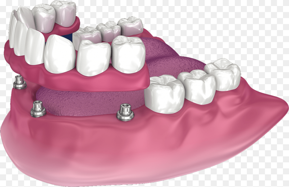 Snap On Dentures In San Diego Full Denture With Precision Attachments, Birthday Cake, Person, Mouth, Food Png Image