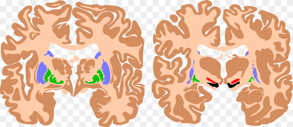 Spastic Cerebral Palsy Brain, Ct Scan, Baby, Face, Head Free Png