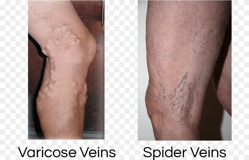 Spider Veins, Person, Skin, Body Part, Knee Free Png