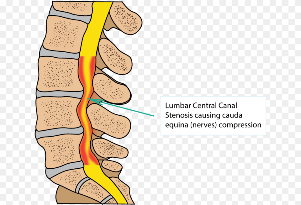 Spinal Stenosis, Face, Head, Person Png