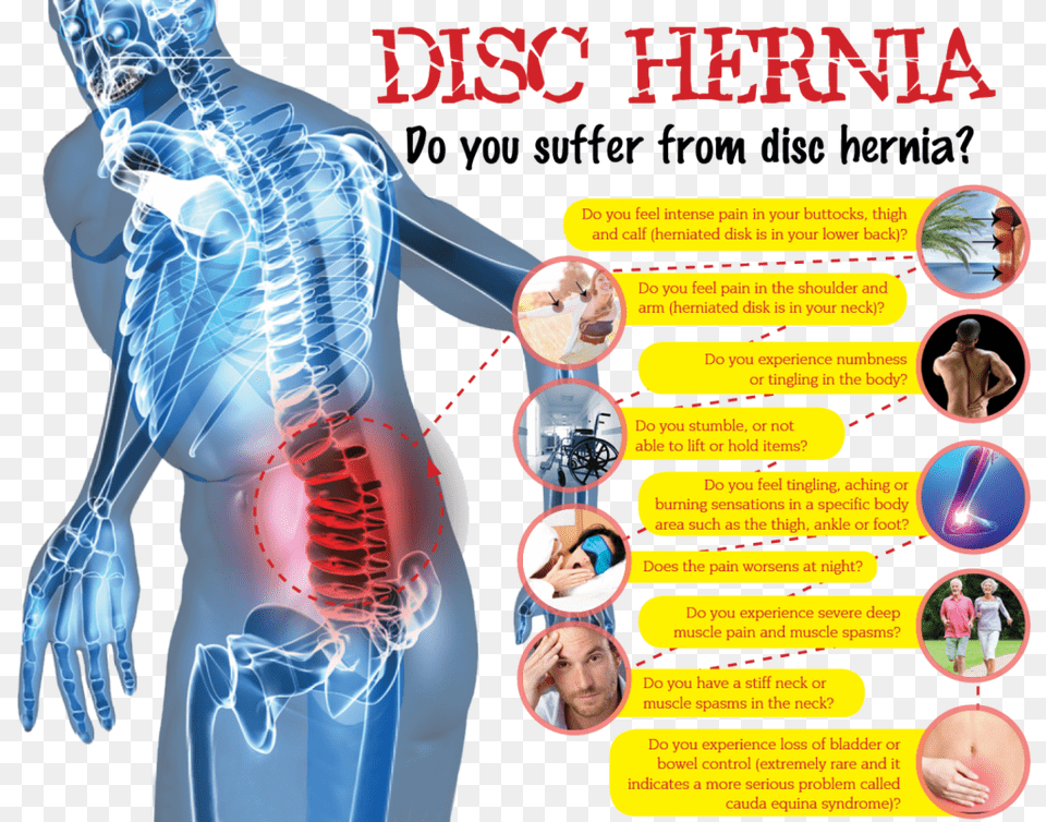 Spine Surgery Infographic, Person, Adult, Male, Man Png