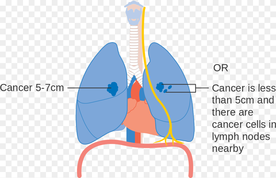 Stage 1 Early Stage Lung Cancer Free Png Download
