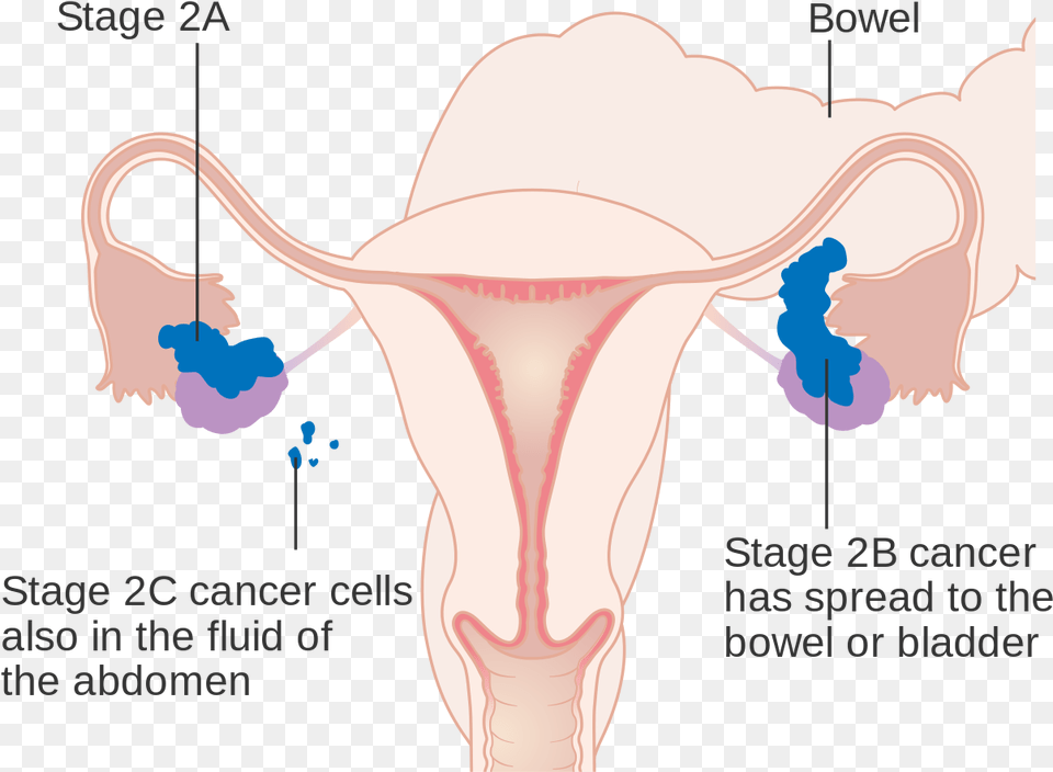 Stage 1 Ovarian Cancer Staging, Chart, Plot, Person Free Png Download