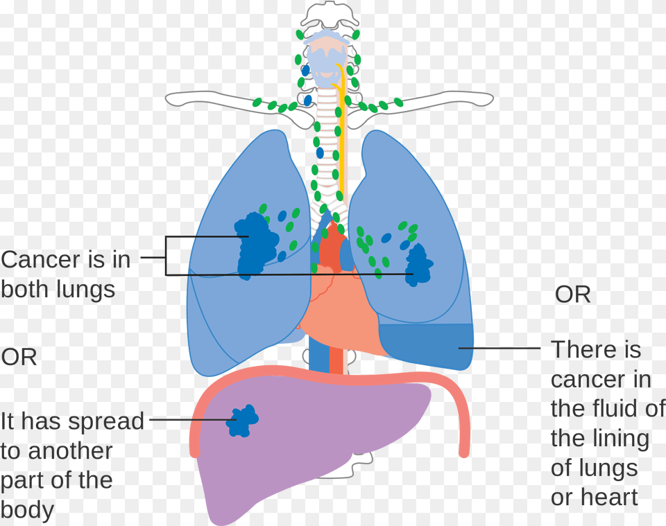 Stage 4 Lung Cancer Diagram, Ct Scan, Chart, Plot, Person Free Transparent Png