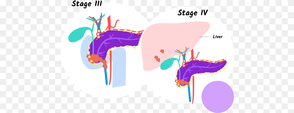 Stages Of Pancreatic Cancer Pancreatic Cancer Stafe 4, Ct Scan Png