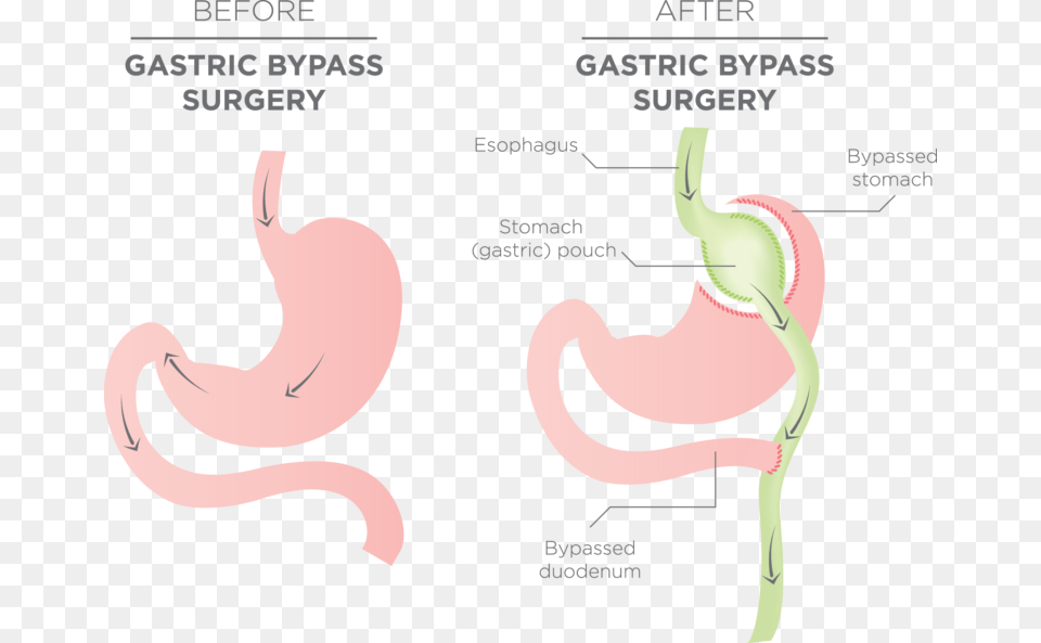 Stomach Before And After Gastric Bypass, Body Part Png Image