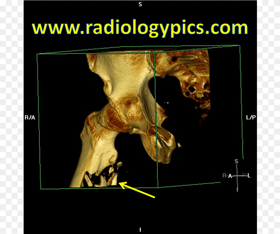 Subtrochanteric Femur Fracture Computed Tomography, Ct Scan, Animal, Horse, Mammal Png Image