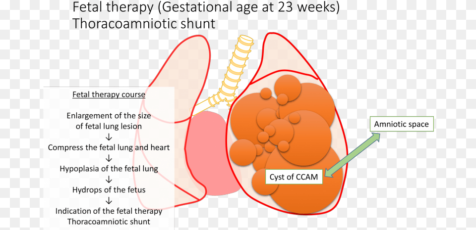 Successful Treatment For A Severe Case Of Fetal Lung, Food, Ketchup Png