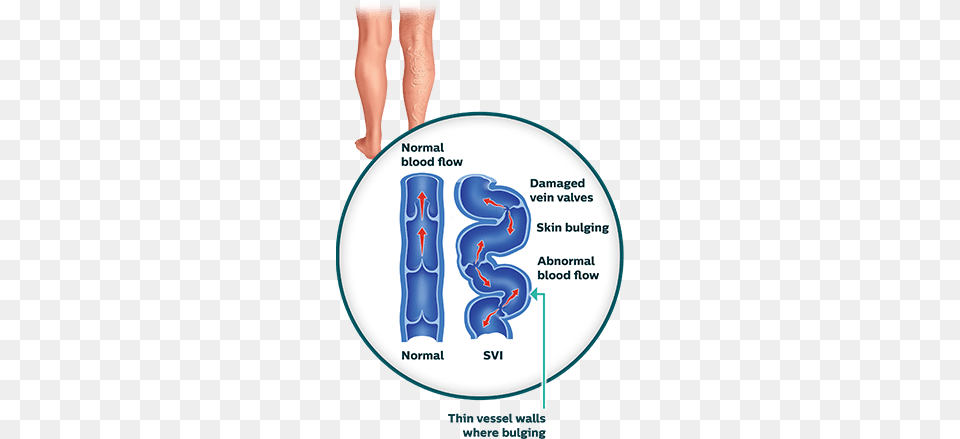 Superficial Venous Insufficiency Graphics, Disk, Adult, Bride, Female Free Transparent Png