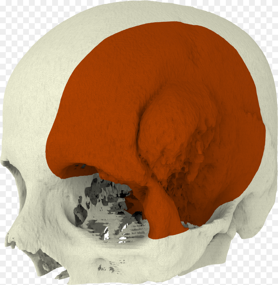 Surgical Guide Cranial Implants, Head, Person, Face Free Png