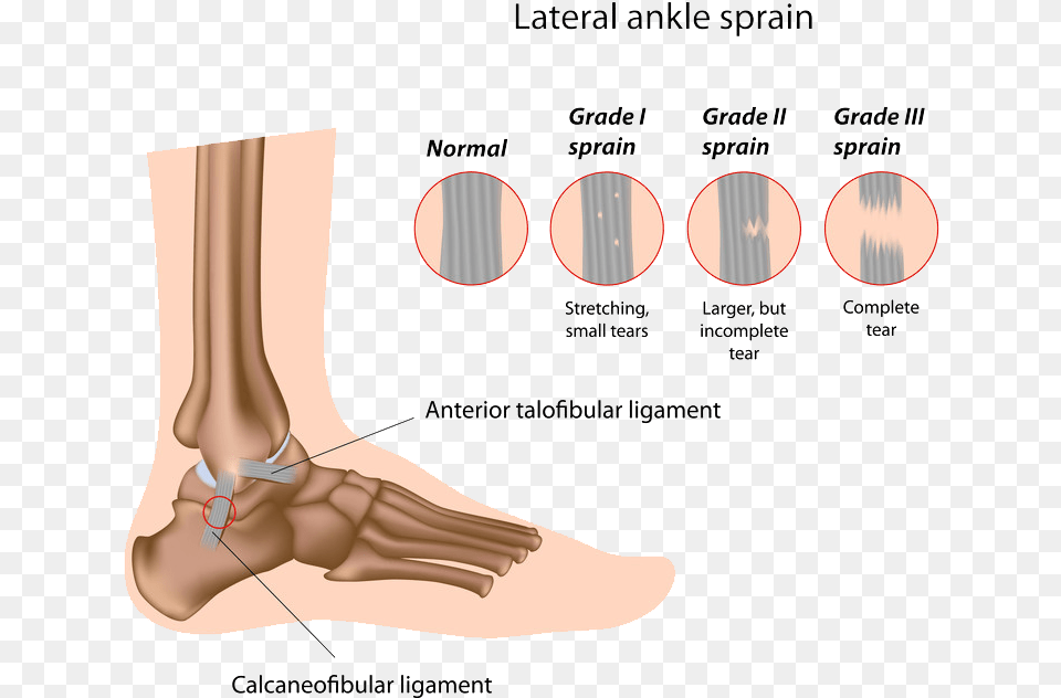 Surgical Options Sprained Ankle Grade, Body Part, Person, Adult, Female Free Transparent Png