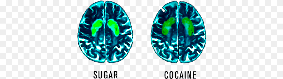 Sweet Tooth Foggy Brain U2014 Russell Boon Sugar Affects Your Brain, Ct Scan, Astronomy, Moon, Nature Png