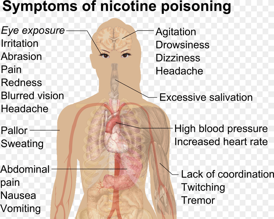 Symptoms Of Nicotine Poisoning Nicotine Poisoning, Adult, Female, Person, Woman Free Png