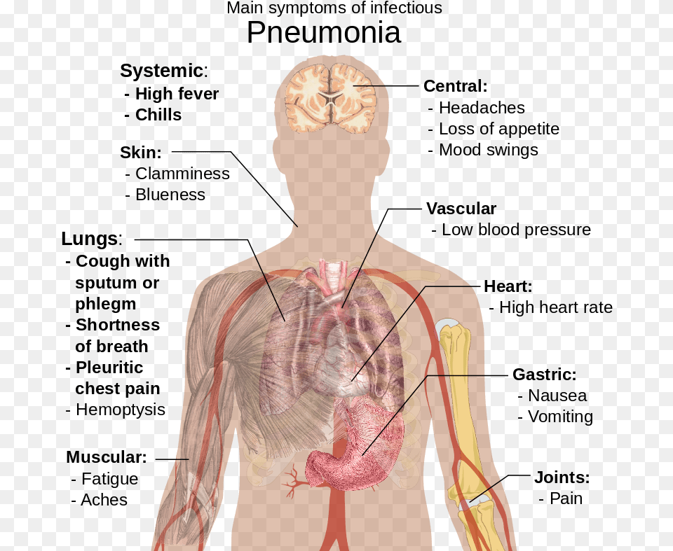 Symptoms Of Pneumonia Pneumonia Sign And Symptom, Adult, Male, Man, Person Free Png