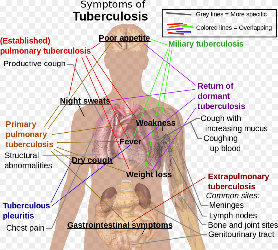 Symptoms Of Tuberculosis Respiratory System Tuberculosis, Adult, Male, Man, Person Free Png