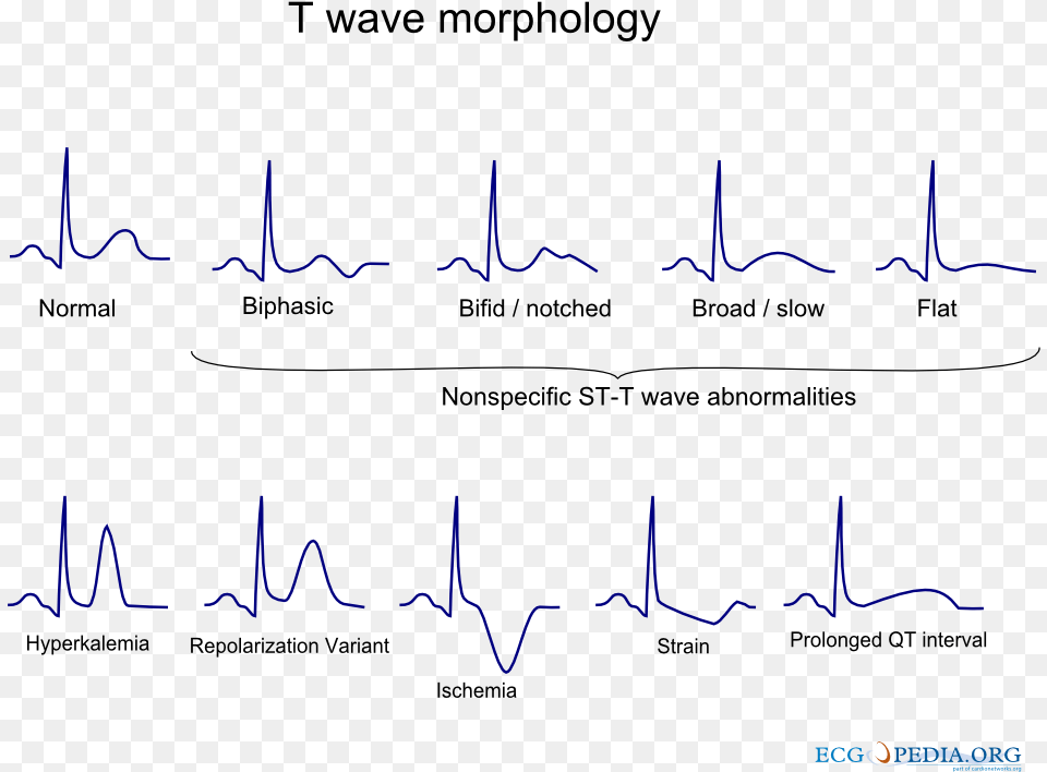 T Wave Abnormality, Text Free Transparent Png