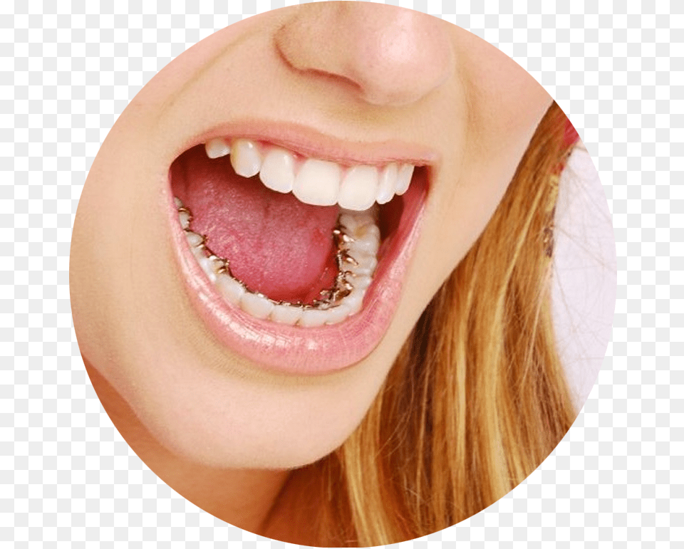 Teeth Inside Braces, Body Part, Mouth, Person, Head Png