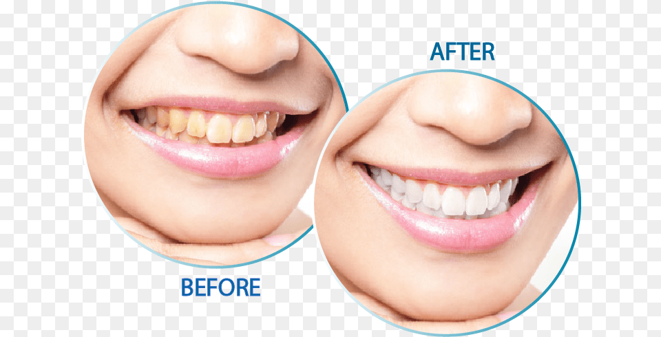Teeth Whitening Peridex Stain, Body Part, Mouth, Person, Baby Free Png