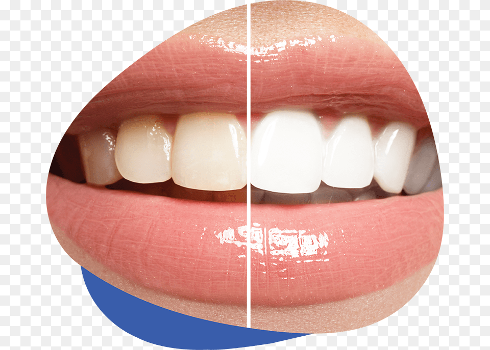 Teeth Whitening Ranking Past Do Zbw Wybielajcych, Body Part, Mouth, Person, Egg Free Transparent Png
