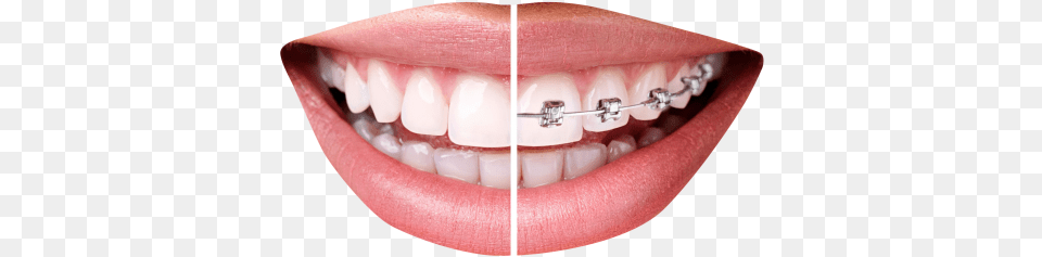Teeth With Braces Transparent Image Dientes Con Brackets, Body Part, Mouth, Person, Face Free Png