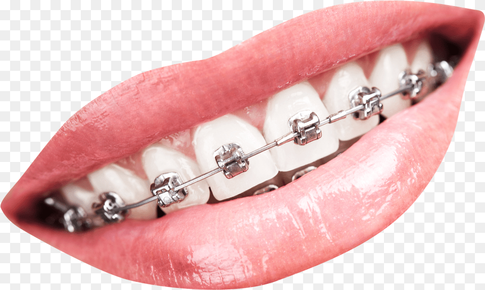 Teeth With Braces Image Teeth With Braces, Body Part, Mouth, Person, Brace Free Transparent Png