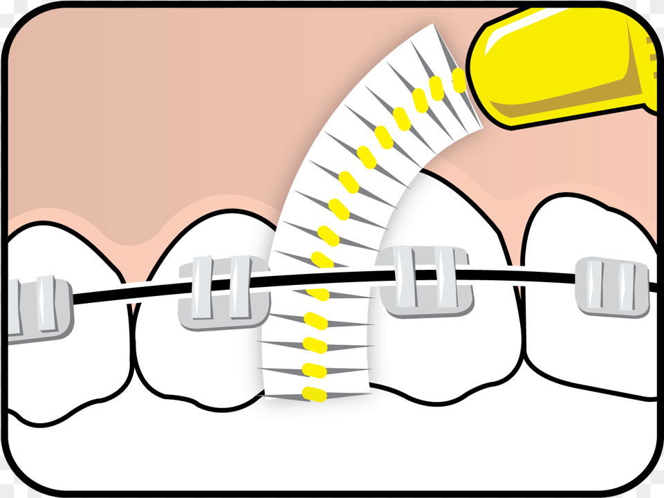 Tepe Interdental Brush On Braces Diagram, Body Part, Mouth, Person, Teeth Free Png